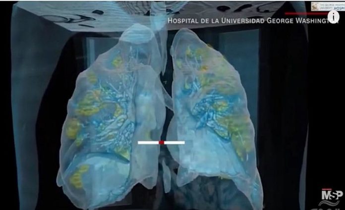 COVID-19 pulmones